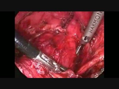 Rectopexia anterior laparoscópica con el uso de una malla