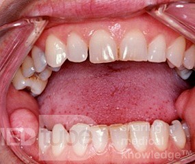 Pólipo fibroepitelial de la mucosa oral