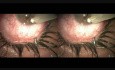 Uveítis posterior - Glaucoma - Filtración Microtrack