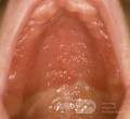 Reacción alérgica a la dentadura postiza