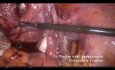 Polimiomectomía laparoscópica estándar