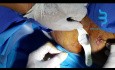 Tratamiento con láser de la fístula anal