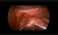 Cardiomiotomía de Heller laparoscópica en paciente de 16 años
