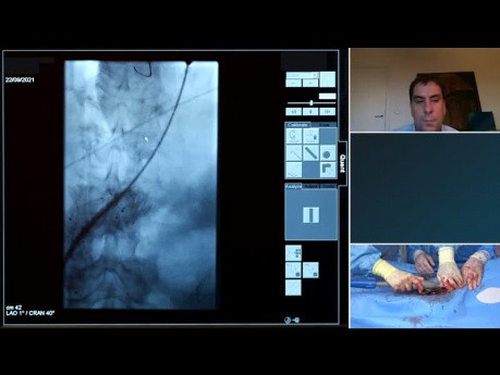 Reintervención de Aneurisma de Aorta Abdominal (AAA) Recidivante con el Sistema de Endoprótesis Endurant IIs