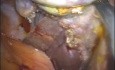 Colecistectomía laparoendoscópica de sitio único (LESS) sin anestesia general