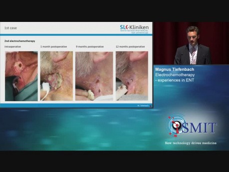 Electroquimioterapia - Experiencias en ORL - SMIT 2019