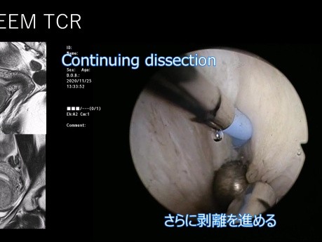 Nueva técnica histeroscópica de disección de pseudocápsulas de miomas
