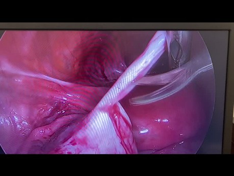 Cistectomía Laparoscópica de Ovario Izquierdo y Adhesiolisis