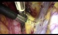 La histerectomía radical laparoscópica tipo B con aislamiento del tumor cervical