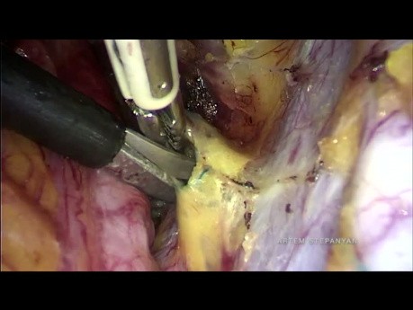 La histerectomía radical laparoscópica tipo B con aislamiento del tumor cervical