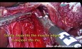Miotomía de Heller laparoscópica con funduplicatura de Dor: ¿Cómo lo hago?
