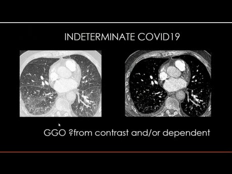 Imágenes torácicas - COVID-19