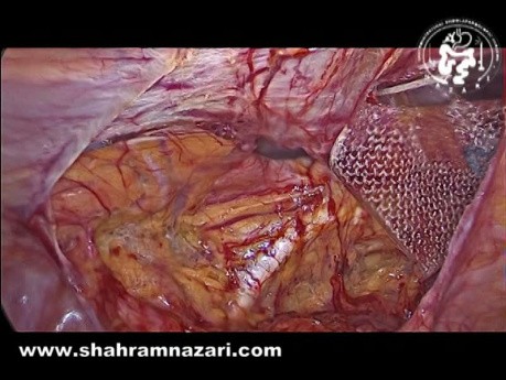 Reparación transabdominal preperitoneal  (TAPP) para hernia inguinal recurrente