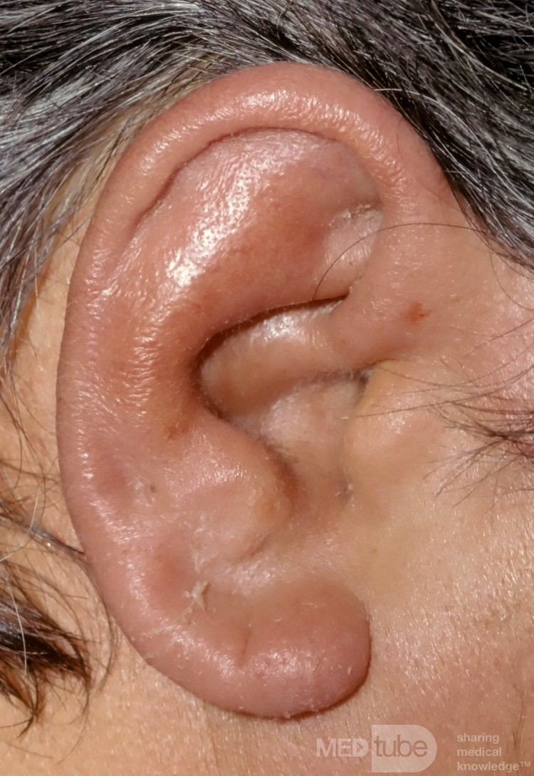 Pericondritis aguda
