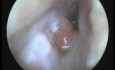 Un pólipo inflamatorio del conducto auditivo - limpieza por succión