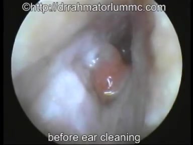 Un pólipo inflamatorio del conducto auditivo - limpieza por succión