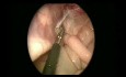 Piloromiotomía laparoscópica y sutura percutánea del anillo inguinal en un bebé de 47 días de vida