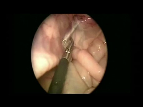 Piloromiotomía laparoscópica y sutura percutánea del anillo inguinal en un bebé de 47 días de vida