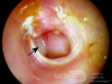 Otitis media purulenta crónica - estadio activo