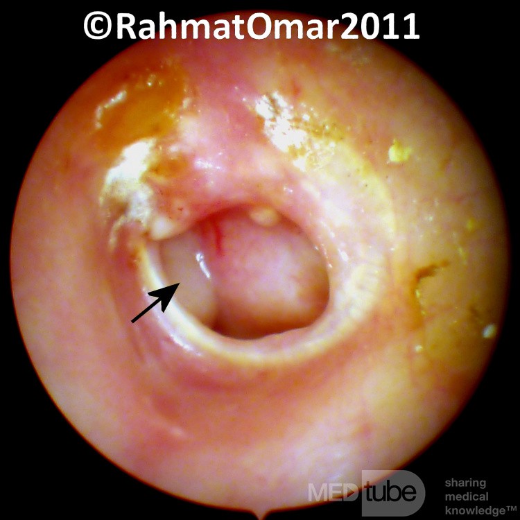 Otitis media purulenta crónica - estadio activo