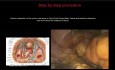 Resección rectal laparoscópica abdominoperineal con escisión mesorrectal total para un tumor anorectal grande (con dibujos)
