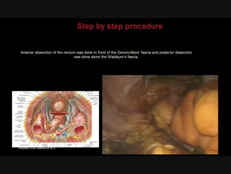 Resección rectal laparoscópica abdominoperineal con escisión mesorrectal total para un tumor anorectal grande (con dibujos)