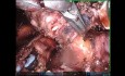 Tumor bronquial de difícil localización