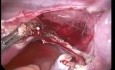 Cuerno rudimentario no comunicante - extirpación de 19 semanas de embarazo realizada con laparoscopia