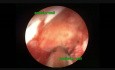 Laceración de la pelvis renal durante la nefrolitotomía percutánea.