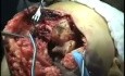 Artroplastia de codo para fractura intercondílea del húmero distal