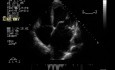 Válvula mitral flácida con insuficiencia mitral grave
