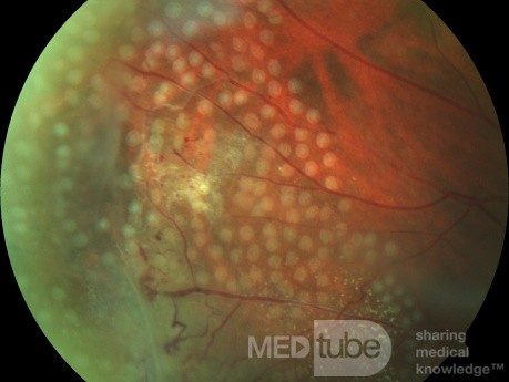 Fotocoagulación con láser de retina en la enfermedad de Coats