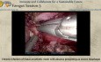 Infección crónica de malla protésica hiatal con absceso que se presenta como disfagia grave.