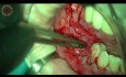 Reconstrucción ósea mandibular con bloque óseo