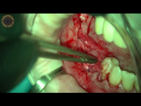 Reconstrucción ósea mandibular con bloque óseo