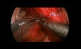 Funduplicatura de Toupet posterior parcial laparoscópica