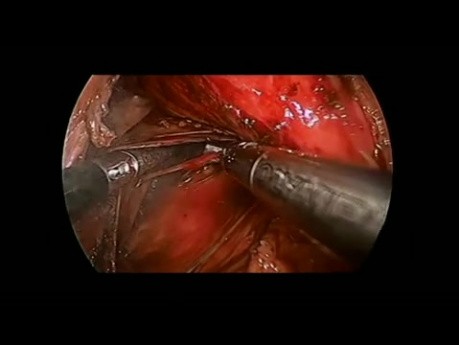 Funduplicatura de Toupet posterior parcial laparoscópica