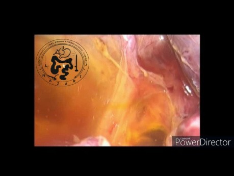 Exploración laparoscópica del conducto biliar común y coledocoscopia intraoperatoria
