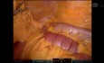 Resección robótica del intestino delgado para la invaginación intestinal