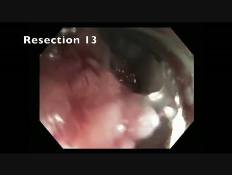 Extirpación de un pólipo de colon