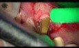 Terapia de implantes estéticos con láser YSGG