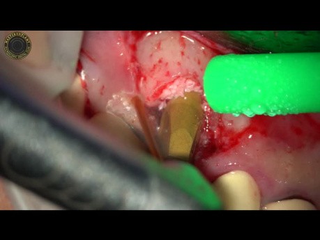 Terapia de implantes estéticos con láser YSGG