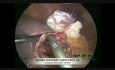 Cistogastrostomía laparoscópica para el tratamiento de pseudoquiste pancreático