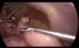 Gastrectomía en manga con conversión laparoscópica a bypass de Roux en Y con reparación de hernia hiatal