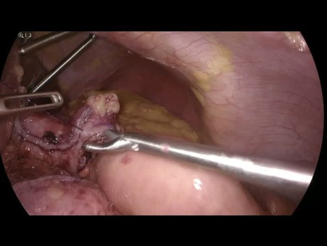 Gastrectomía en manga con conversión laparoscópica a bypass de Roux en Y con reparación de hernia hiatal