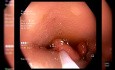 ¿Nos atrevemos? - Lesión colónica apta para endoscopia o cirugía