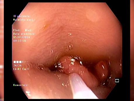 ¿Nos atrevemos? - Lesión colónica apta para endoscopia o cirugía