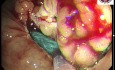 Resección mucosa endoscópica de tumor con extensión lateral en el colon derecho