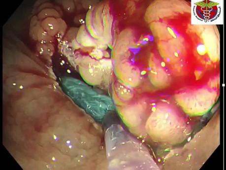 Resección mucosa endoscópica de tumor con extensión lateral en el colon derecho