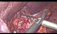 Gastrectomía laparoscópica para el cáncer de estómago distal